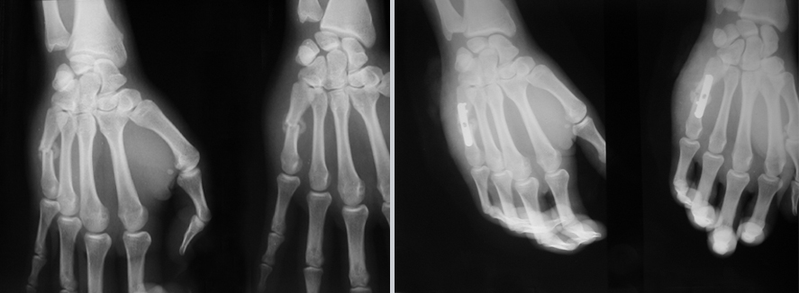 Sekundarna osteosinteza pločicom i vijcima